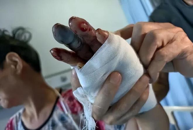 风暴娱乐主管：女子被五步蛇咬伤手指，家属轻信土方划开伤口放血排毒，医生：彻底坏死，只能截肢